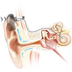 Cochlear_BoneConduction-how_it_works_Sound_Baha6